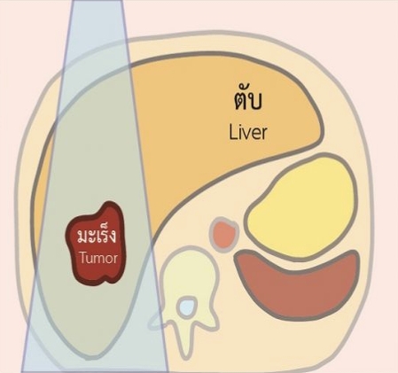 เอกสารแนะนำเกี่ยวกับโรคมะเร็ง