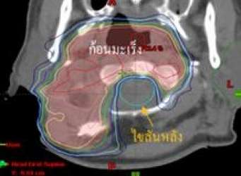การวางแผนการรักษาด้วยเทคนิคปรับความเข้ม(IMRT)