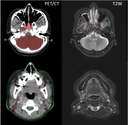 การจำลองโดยใช้ภาพจากเครื่องเพ็ทซีที (PET/CT simulator)